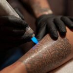 Fjernelse af tatovering i Odense