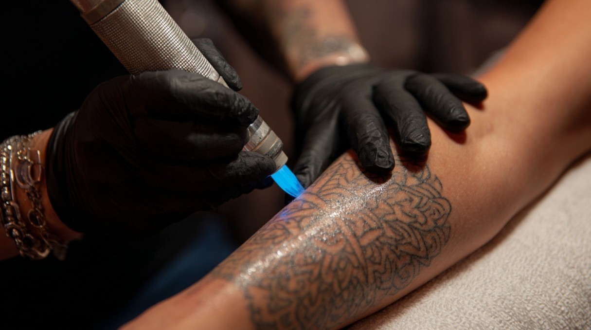 Fjernelse af tatovering i Odense